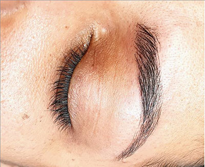 micro blanding institut Angers 49